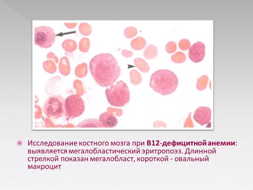 Витамины при в12 дефицитной анемии. Анемия при в12 дефицитной анемии. миелограмма при в12 дефицитной анемии.