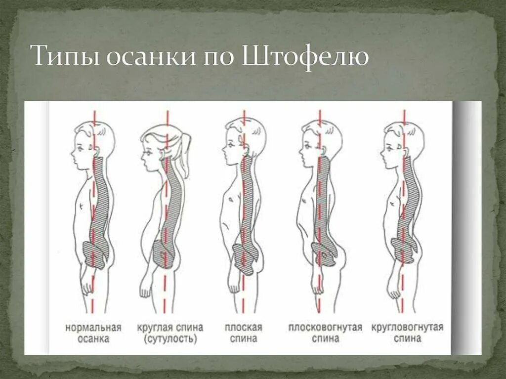 Нарушение осанки в сагиттальной плоскости. Тип осанки сагиттальная плоскость. Типы осанки человека по штаффелю. Плосковогнутая спина у детей. Изгиб кпереди