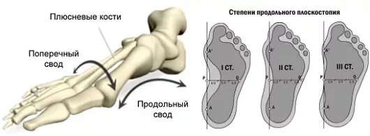 24 свод. Анатомия стопы плоскостопие продольное. Продольное плоскостопие схема. Стопа анатомия плоскостопие. Продольная плоскостопия анатомия.