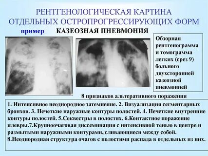 Диагностика туберкулеза рентген