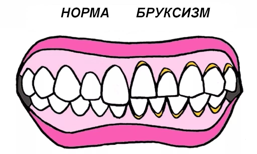 Бруксизм у детей причины. Бруксизм жевательных мышц. бруксизм скрежетание зубами.