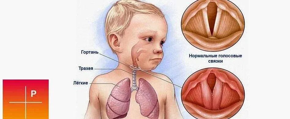 Ларингит симптомы у детей до года. Ларингит симптомы у детей до года