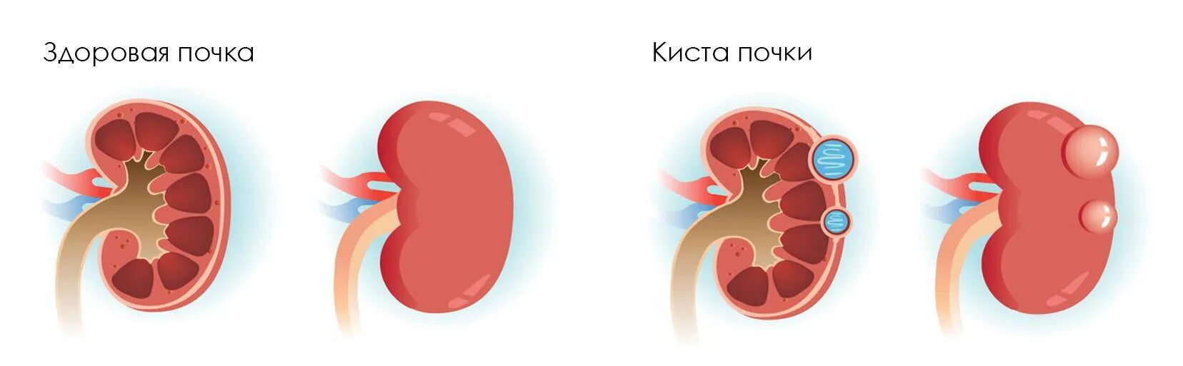 Киста в почке лечение у взрослых женщин. Косты почек.