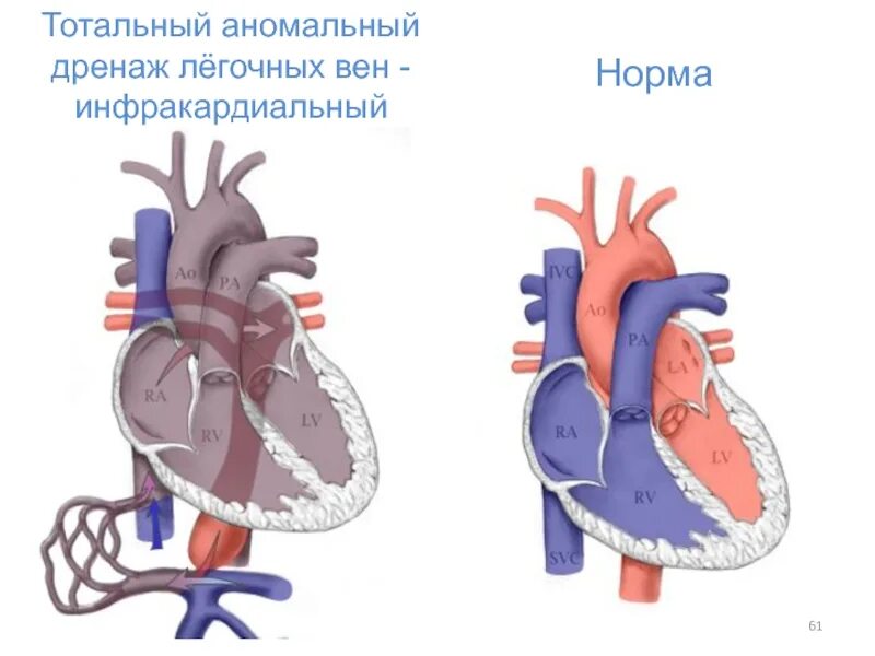 Аномальный дренаж легочных вен схема. Аномальный дренаж легочных вен типы. Частичный аномальный дренаж легочных вен у новорожденных. Тотальный аномальный дренаж легочных вен. Тотальная аномалия дренажа легочных вен.