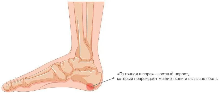 Боль в пятке при наступании на ногу. Болит пятка снаружи сбоку. Болит пятка при наступании. Болит пятка на правой ноге причины
