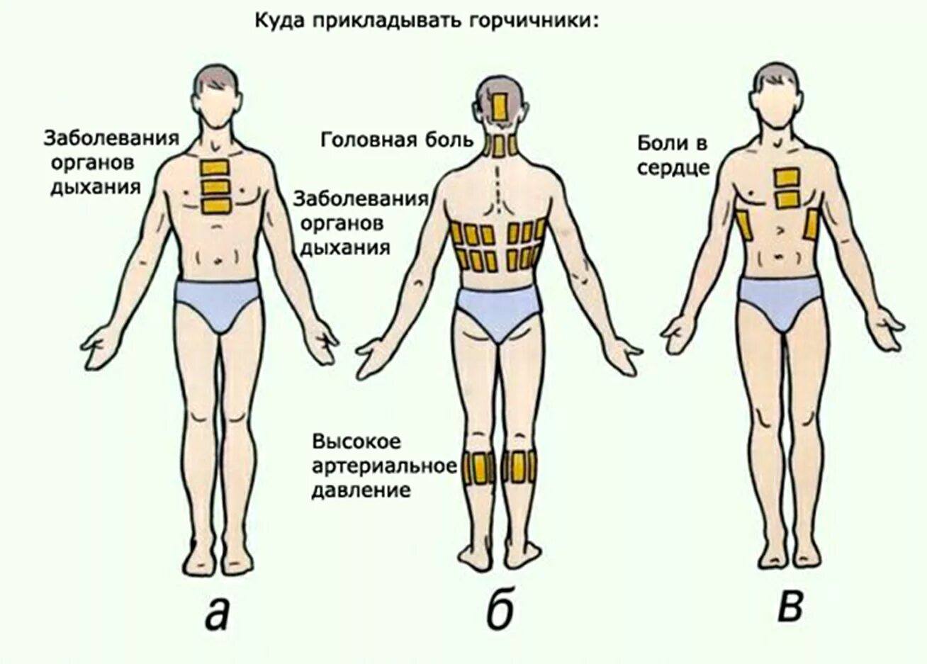 Области можно. Схема постановки горчичников при бронхите. Горчичники схема наложения. Схема постановки горчичн Ков при бронхите. Схема накладывания горчичников.