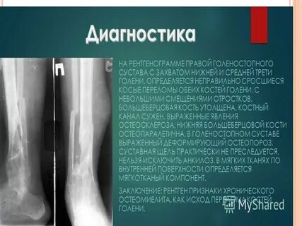 Остеомиелит кости признаки
