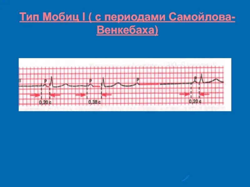 Период венкебаха на экг. Блокады сердца на экг классификация. Ав блокада мобиц 1 и мобиц 2. Са блокада 2 степени мобитц 1 на экг. Атриовентрикулярная блокада 2 степени мобитц.