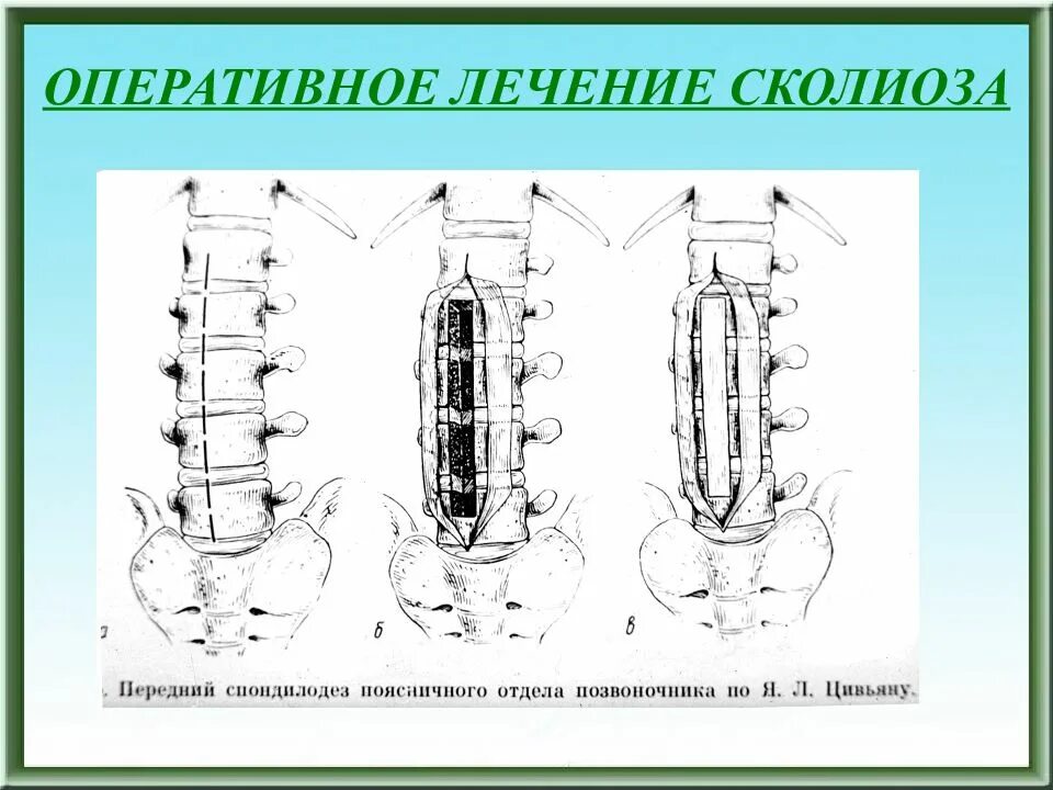 Оперативное лечение позвоночника. Оперативное лечение сколиоза. Оперативная коррекция сколиоза. Оперативные методы лечения сколиоза. Оперативная хирургия лечения сколиоза.