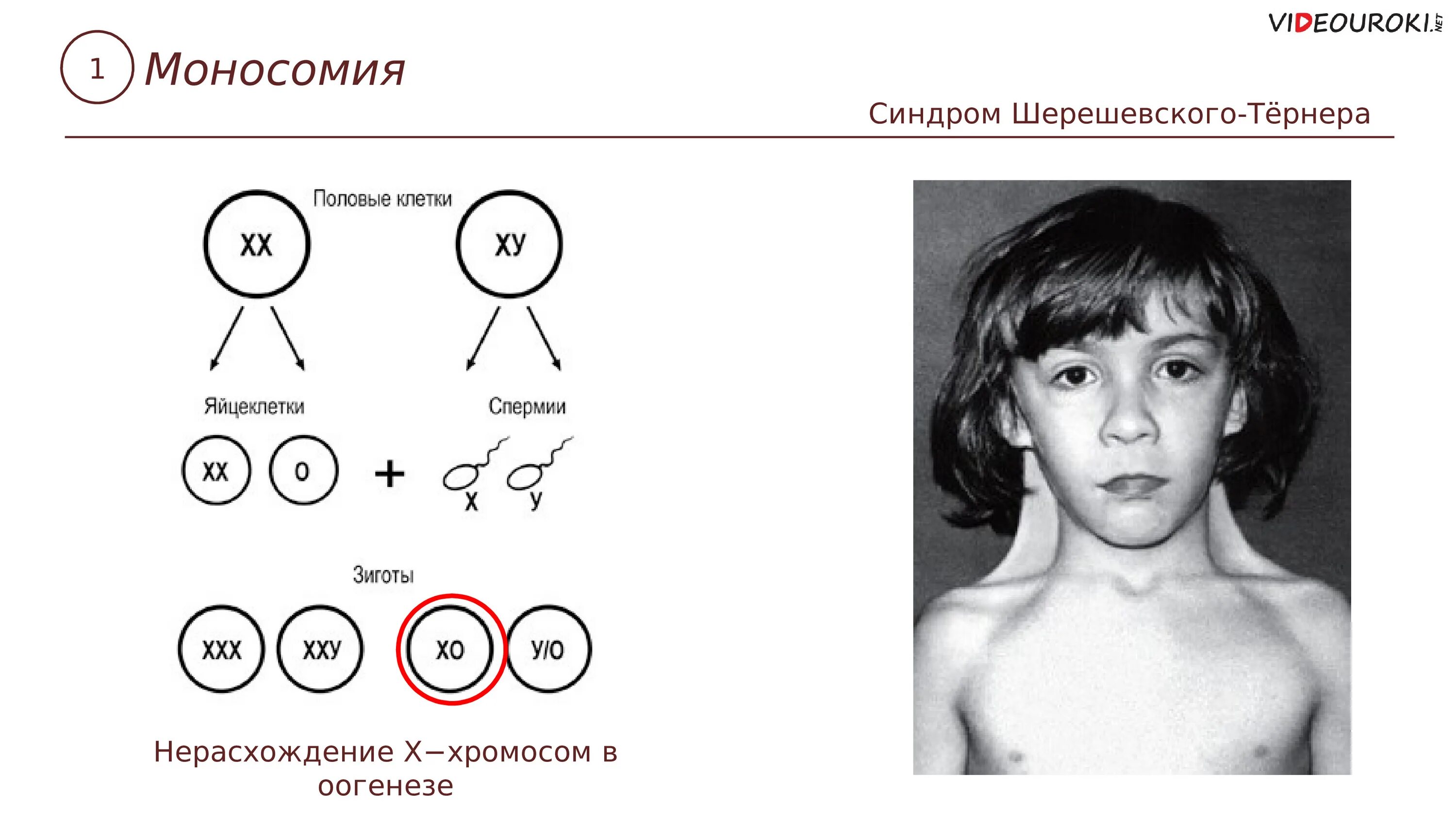 Отсутствие х хромосомы у мужчин. Синдром Шерешевского Тернера. Моносомия Шерешевского Тернера. Синдром Шерешевского Тернера схема. Синдром Шерешевского Тернера хромосомы.