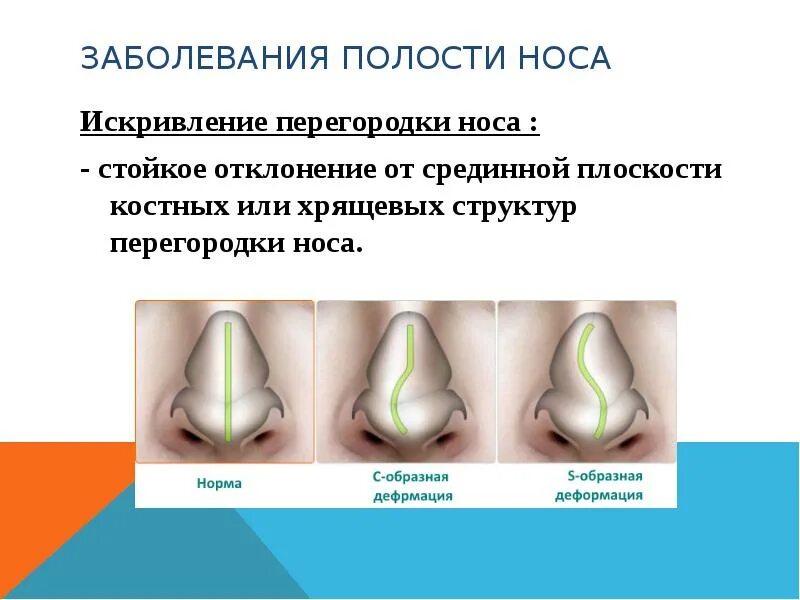 Острый ринит - YouTube