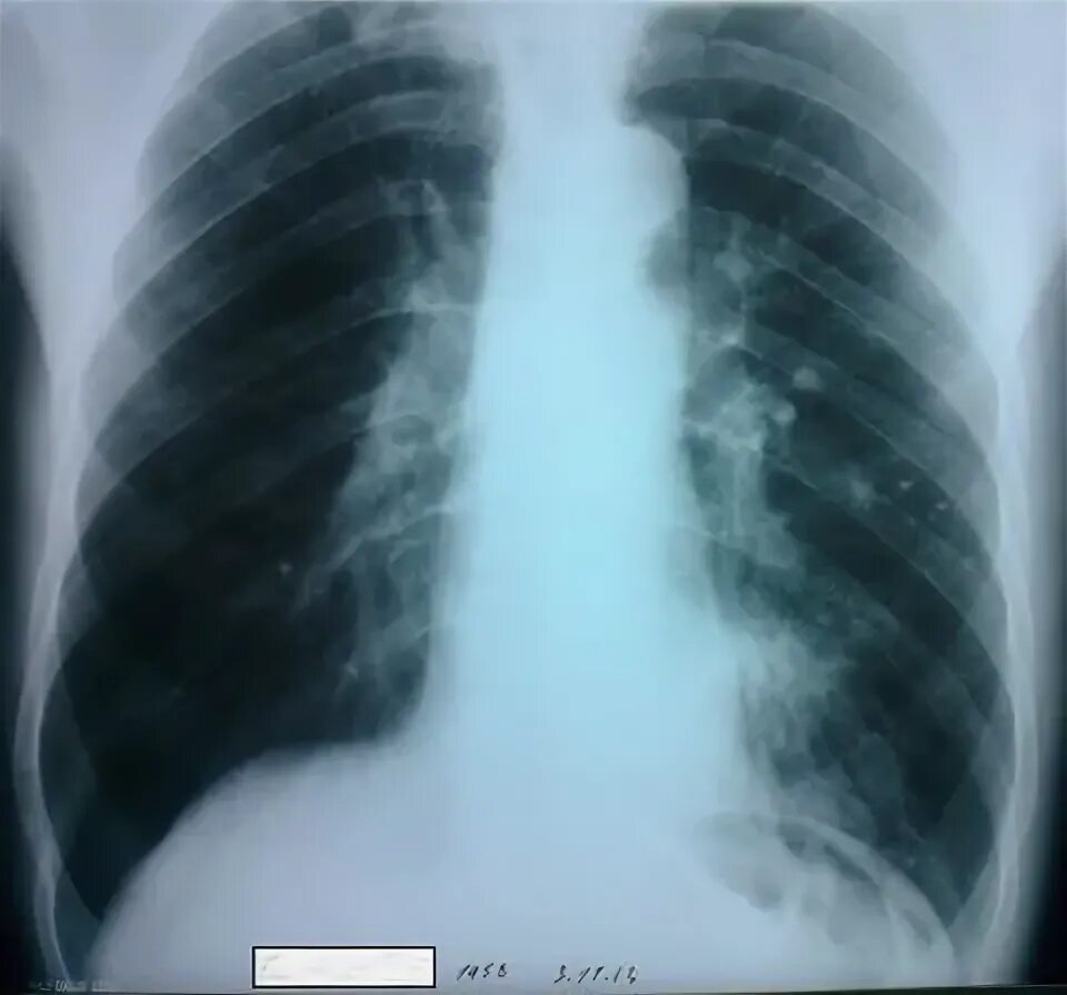 правосторонняя нижнедолевая очаговая пневмония рентген. внебольничная пневмония нижней доли правого легкого. нижнедолевая пневмония рентген. нижнедолевая очаговая пневмония рентген. нижнедолевая пневмония справа рентген.