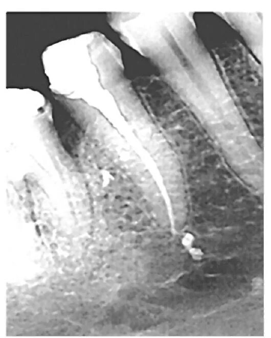 Фиброзный периодонтит. Хронический периодонтит рентген. Фиброзный апикальный периодонтит. Периодонтит зуба рентген. Периодонтит 3-х канальный * — 7500 р..