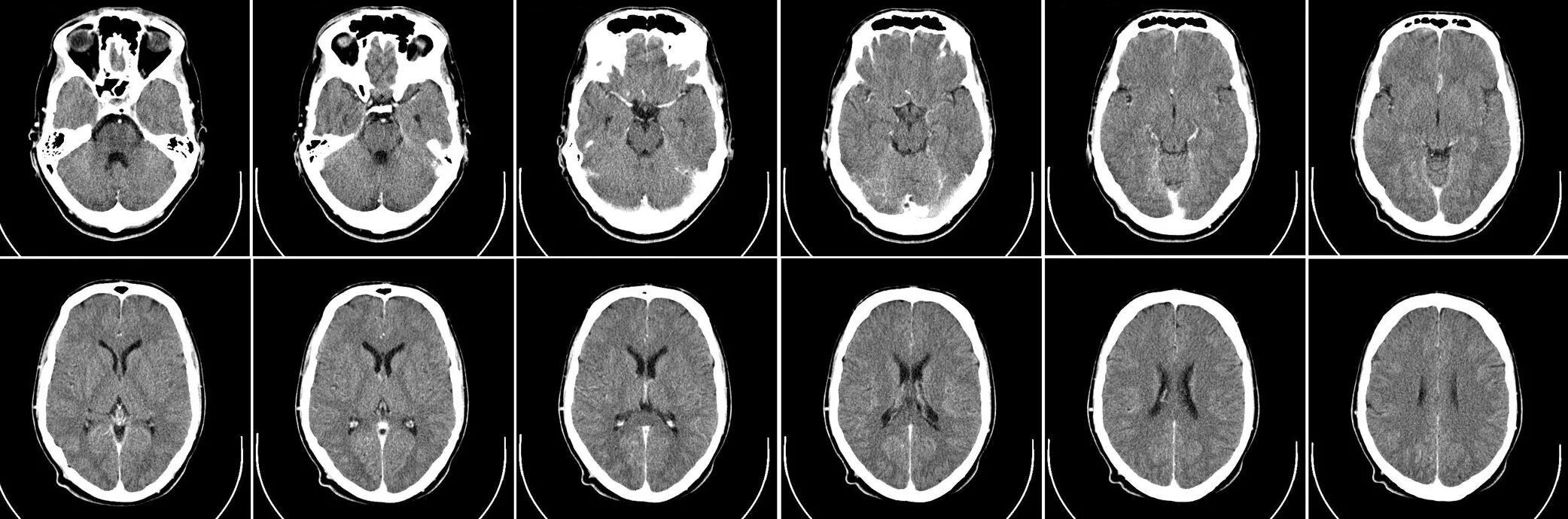 Кт головного мозга норма. Разновидности кт. Кт головы. Головной мозг на кт-томографии.