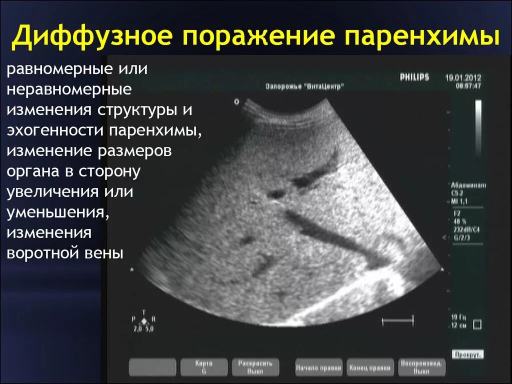 Печень эхогенность диффузно. Паренхима-УЗИ поджелудочной железы. Паренхима печени диффузно изменена. Диффузные изменения поджелудочной железы на УЗИ. УЗИ признаки диффузных изменений паренхимы поджелудочной железы.