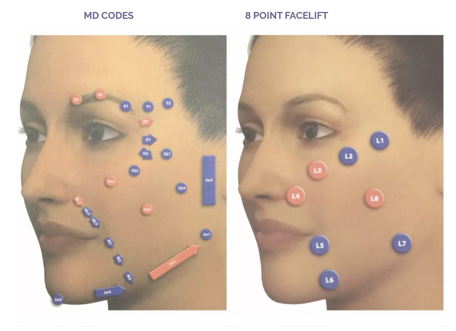 Мезотерапия ДМАЕ схема введения. Опасные зоны для введения филлеров на лице. Точки введения липолитиков в лицо. Точка уколова