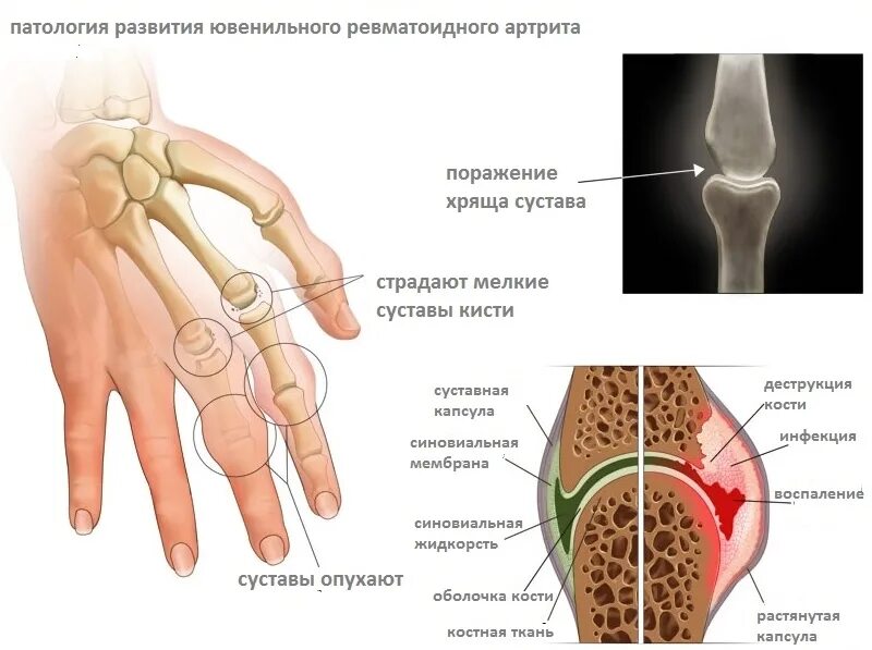 Воспаление суставов заболевание. Ювенильный ревматоидный артрит. Ревматоидный артрит поражение суставов. Ювенильный ревматоидный артрит суставная форма. Ревматоидный артрит пораженные суставы.