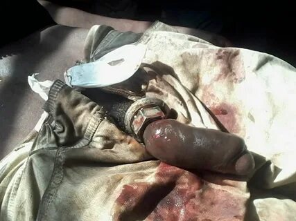 Photos; Man Puts Bolt On His Pennis - Doctor Places Bolt Cutters To Remove ...