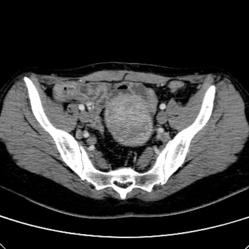 Кт органов таза у мужчин. Малый таз на кт томограмма. Кт малого таза норма. Кт исследование малого таза с контрастированием. Исследования органов малого таза кт.
