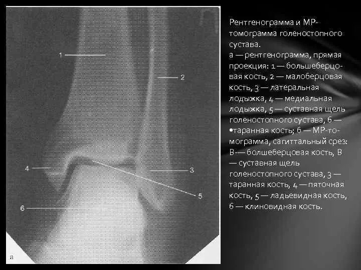 Малоберцовая кость рентген анатомия. Голеностопный сустав рентген анатомия рентгеноанатомия. Рентгеновская суставная щель большеберцовой кости. Проекции голеностопного сустава рентген.