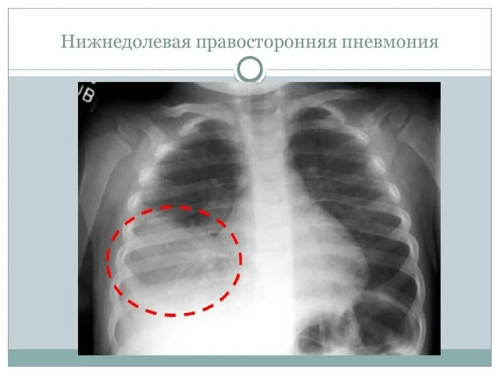 Пневмония в правой нижней доле. Правосторонняя нижнедолевая пневмония рентген. Правосторонняя нижнедолевая очаговая пневмония рентген. Нижнедолевая очаговая пневмония рентген. Левосторонняя очаговая пневмония рентген.