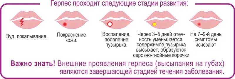 Почему появляется герпес на губах причины. Стадии появления герпеса на губах. стадии проявления герпеса на губах.