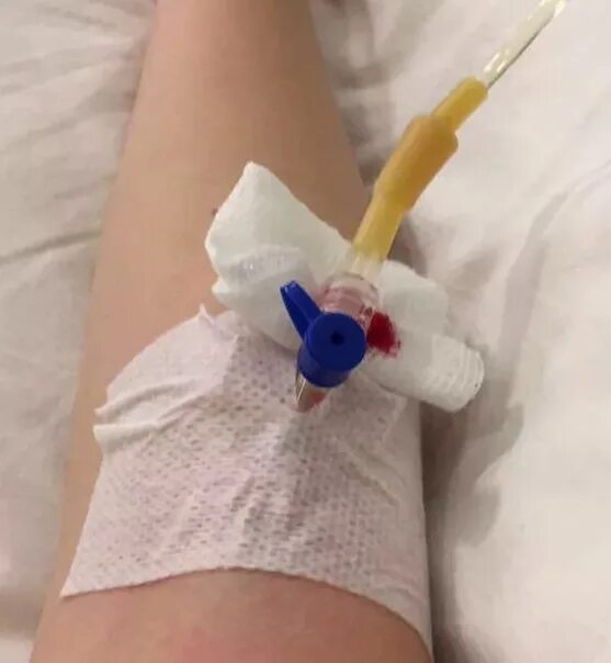 Cannula в руке стоковое изображение. изображение насчитывающей игла - 53657759