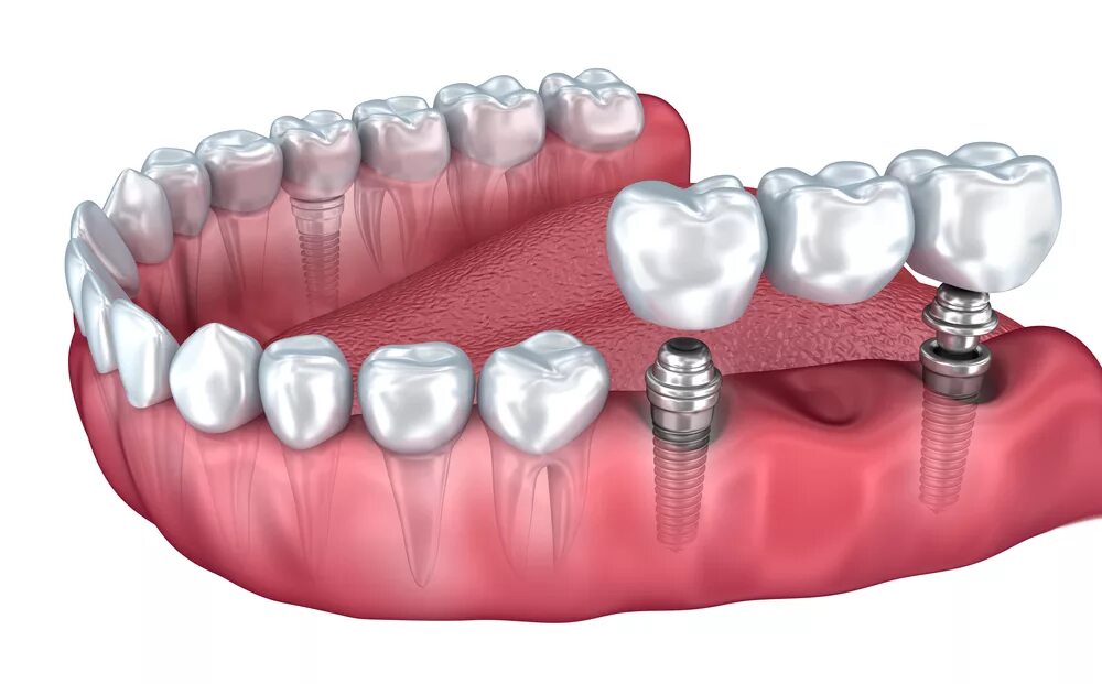 Мостовидный протез на имплантах 3 зуба. Несъёмный мостовидный протез челюсти. Мостовидный протез на 2 имплантах. Зубной мост мостовидный протез.