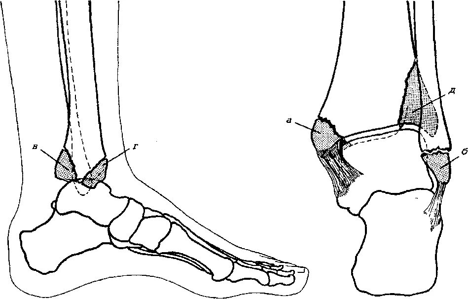 Внутренний голеностопный сустав. Перелом наружней лодыжки заднего края большеберцовой кости. Перелом латеральной лодыжки большеберцовой кости. Перелом наружной лодыжки большеберцовой кости. Перелом наружного края большеберцовой кости.