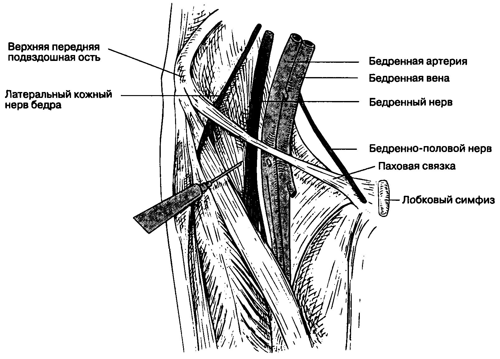 Невропатия полового нерва. Блокада наружного кожного нерва бедра. Техника блокады запирательного нерва. Блокада бедренного, седалищного и запирательного нервов. Блокада латерального кожного нерва бедра техника.