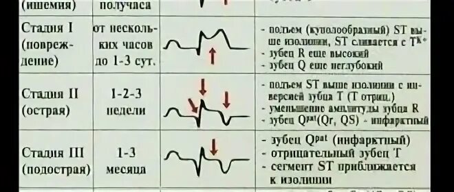 Признак острейшей стадии инфаркта миокарда. Острейший период инфаркта миокарда на ЭКГ. Признаки острейшей фазы инфаркта миокарда на ЭКГ. Острая стадия инфаркта миокарда ЭКГ.