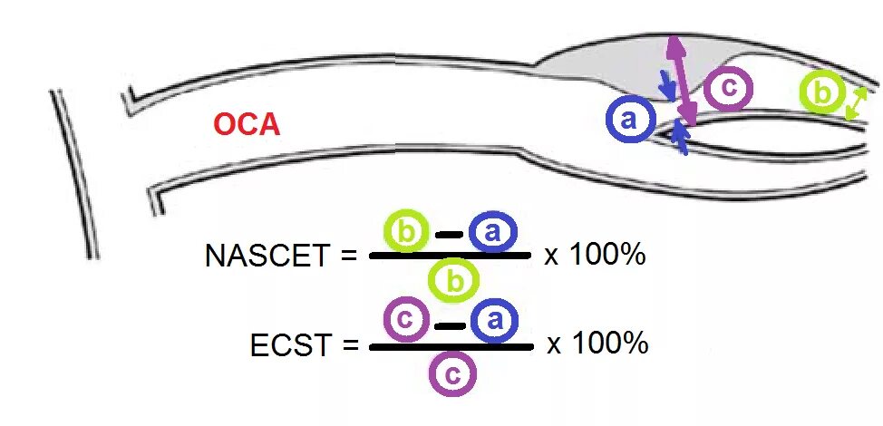 Процент стеноза сосудов. Nascet метод. Ecst стенозы сосудов. Измерение процента стеноза сонной артерии. Классификация стенозов артерии по nascet.