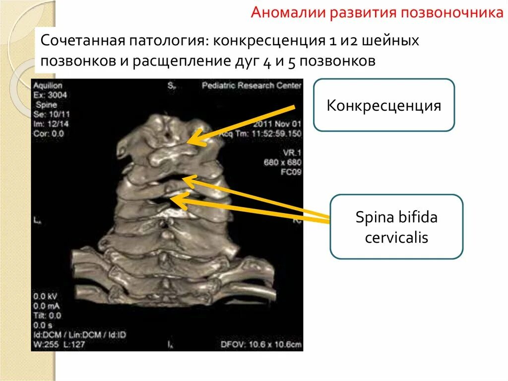 Конкресценция шейных позвонков с5-с6. Конкресценция позвонков с4-с5. Конкресценция с1-с2 рентген. Пороки развития позвоночника.