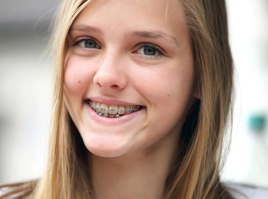 Покажи кривые зубы. Красивые женщины с кривыми зубами. Сапфировые брекеты. Красивые девушки с брекетами. Девушка блондинка с брекетами розовыми.