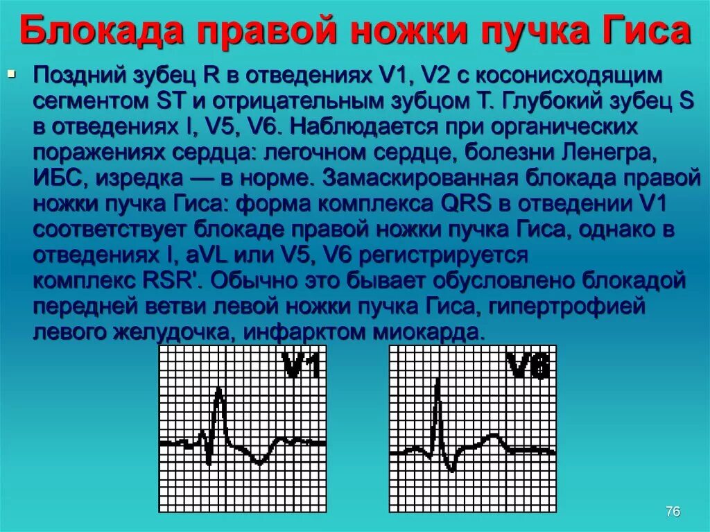 Блокада ножки гиса причины. Блокада правая ножка пучка Гиса. Блокада правой ножки пучка Гиса. Блокада правоц нужки пуска оиса. Блокада правой ножки пучка.