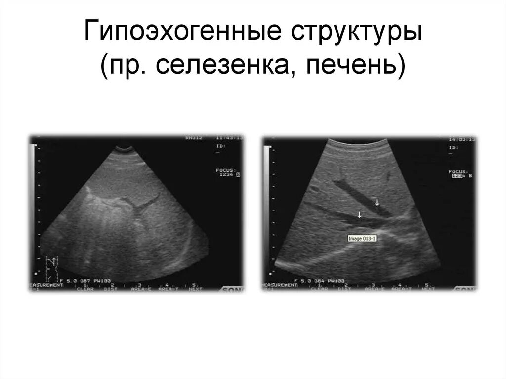 Образование в печени на узи. Гипоэхогенные образования печени на УЗИ. Гипоэхогенное образование в селезенке на УЗИ. Гипоэхогенное образование при УЗИ печени. Гипоэхогенное образование в печени на УЗИ что это такое.