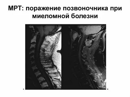 Миеломная болезнь мрт