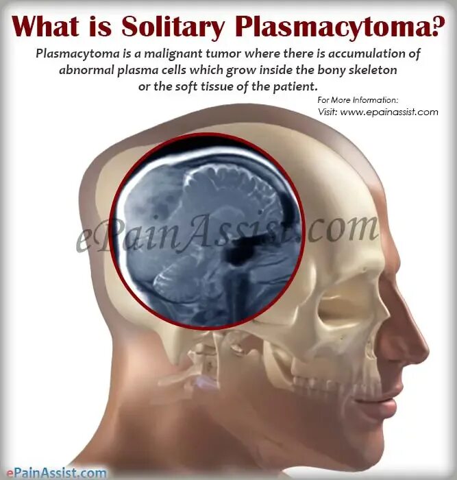 Solitary перевод. Плазмоцитома костей черепа на кт. Плазмоцитома головного мозга. Солитарная плазмоцитома черепа кт.