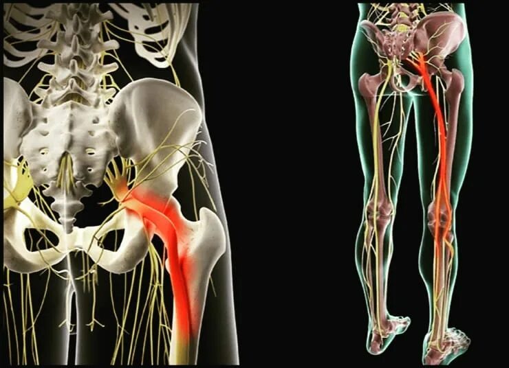 Защемление седалищного нерва симптомы. Неврология седалищный нерв. Седалищный нерв лесера. Неврология седалищный нерв. Седалищный нерв позвоночника.