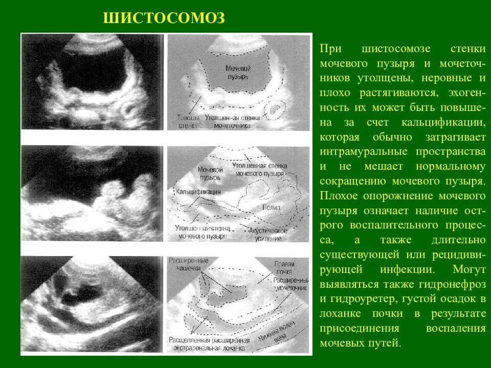 Утолщение мочевого пузыря у мужчин. Стенки мочевого пузыря утолщены УЗИ. Утолщение стенки мочевого пузыря на УЗИ. Шистосомоз мочевого пузыря УЗИ. Утолщенная стенка мочевого пузыря на УЗИ.