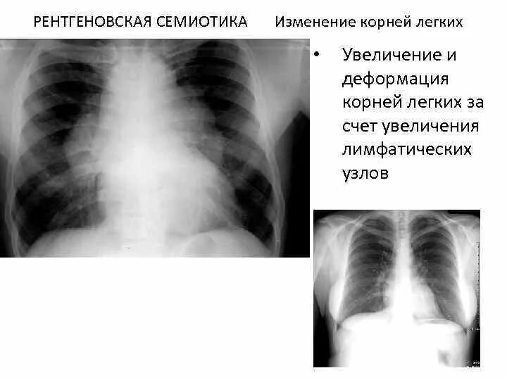 Увеличение корень легкого. Усиление деформация легкого рентген. Патология корня легкого рентген. Деформация левого корня легкого.