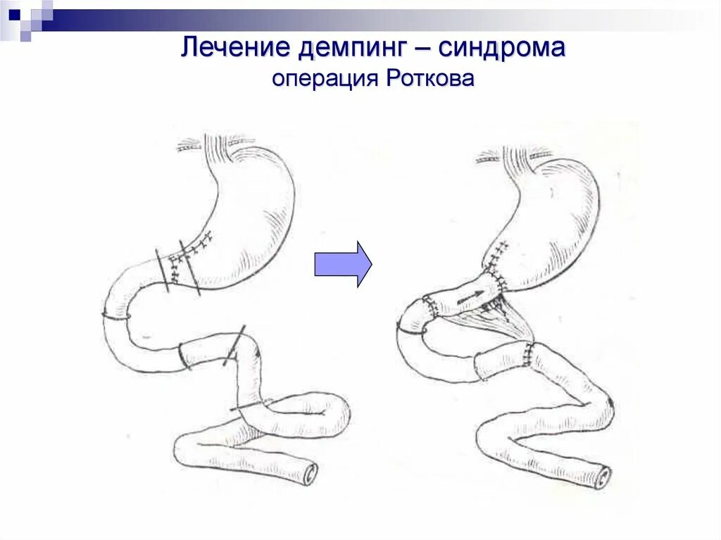 Операция синдром. Демпинг синдром бильрот 1. редуоденизация при демпинг синдроме. операции при демпинг синдроме. реконструктивные операции при демпинг-синдроме.