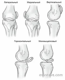 Перелом правого надколенника
