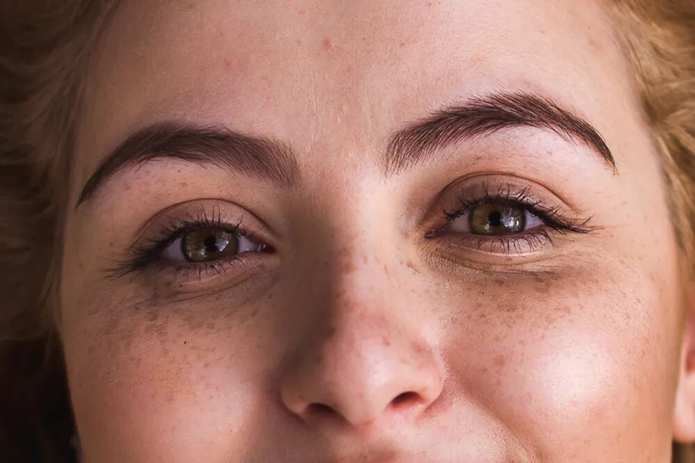 пигментация вокруг глаз. послевоспалительная гиперпигментация. фототерапия от пигментных пятен на лице. пигментация вокруг глаз. пигментация вокруг нлаза.