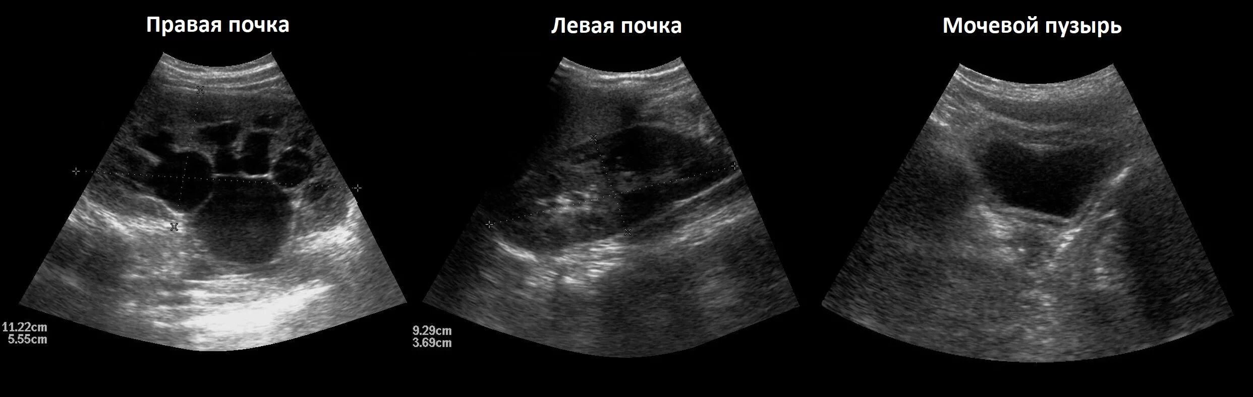 Узи почек диагнозы. УЗИ почек. УЗИ мочевого пузыря. Гидронефроз почки УЗИ. Гидронефроз у детей УЗИ. УЗИ почек, мочеточников и мочевого пузыря..