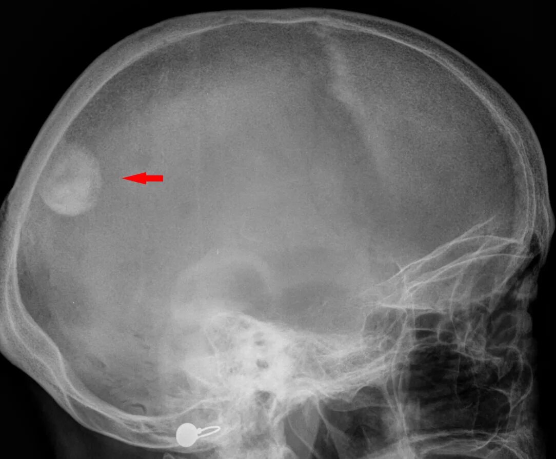 Отросток мозга 4. Менингиома рентген черепа. Остеома теменной кости черепа рентген. Остеома затылочной кости черепа рентген. Остеома костей черепа рентген.
