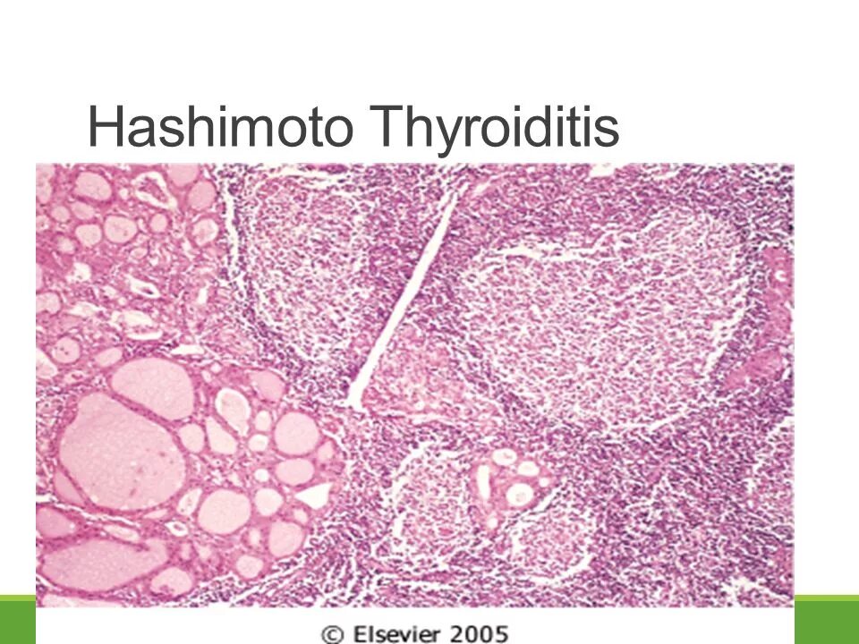 Зоб Хашимото гистология. Аутоиммунный зоб микропрепарат. Тиреоидит Хашимото микропрепарат. Аутоиммунный тиреоидит зоб Хашимото микропрепарат. Аутоиммунный зоб