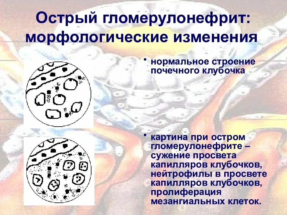 Морфологическое изменение почек