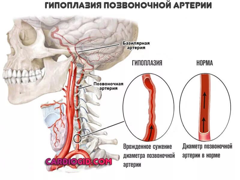 Гипоплазия v4 сегмента правой позвоночной артерии. Гипоплазия позвоночной артерии диаметр сосуда. Гипоплазия v4 сегмента левой позвоночной артерии. Гиперплазия позвоночной артерии.