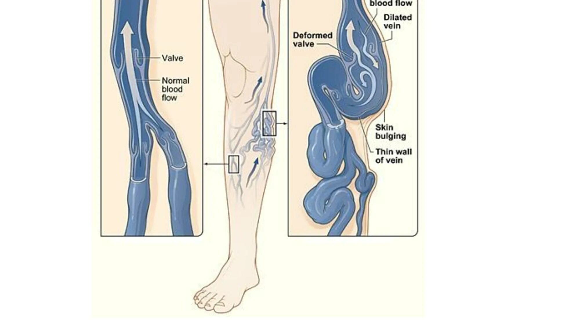 Беременность и заболевание вен. Беременная женщина с отеками. Варикоз при беременности. Варикозное расширение малого таза при беременности. Варикозно расширенные узлы.